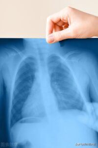肺结节是什么原因_肺部结节形成的原因