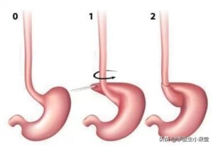 什么是胃食管返流_胃食管返流的治疗